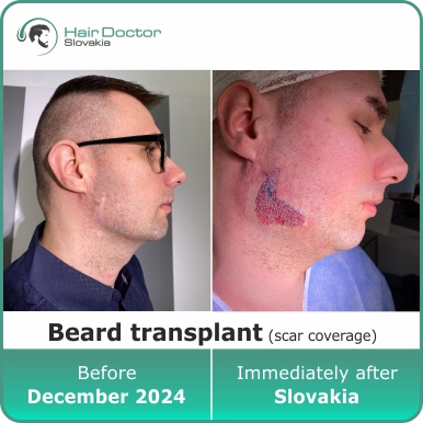 Beard transplant, Slovakia