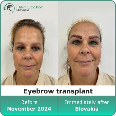 Eeyebrow transplant, Slovakia