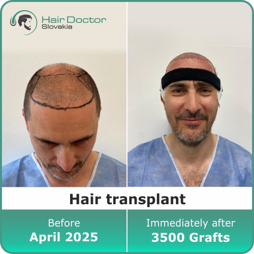 Hair transplant, Slovakia