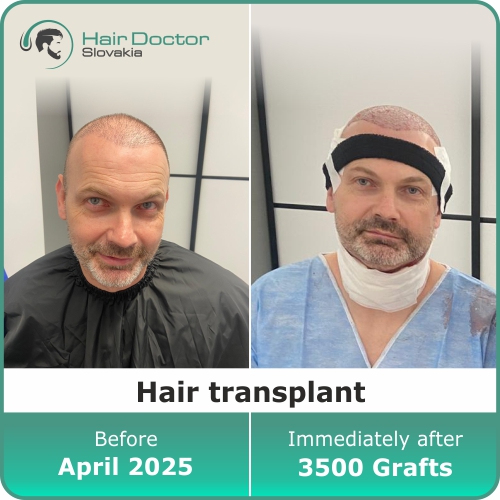 Hair transplant, Slovakia