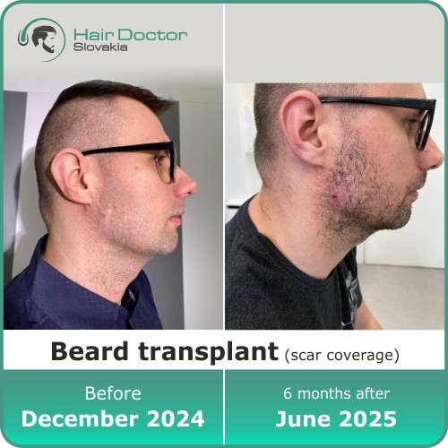 Beard transplant result, Slovakia