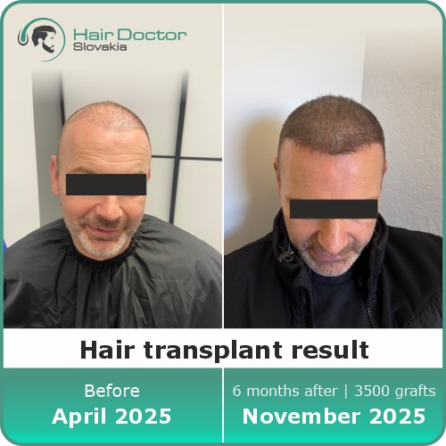 Hair transplant result, Slovakia