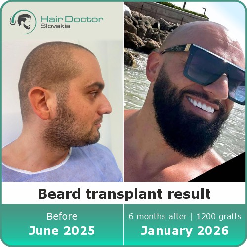 Beard transplant result, Slovakia